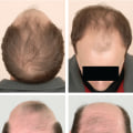 Understanding Hormonal Changes and Male Pattern Baldness