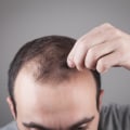 Understanding Thyroid Disorders and Hair Loss