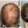 Effective Medical Treatments for Female Hair Loss