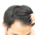 Exercising for Hair Health: Tips and Techniques to Promote Hair Regrowth