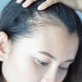 Lifestyle Factors and Female Hair Loss: Understanding the Causes and Risk Factors