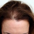 Diagnosing Female Hair Loss: Understanding the Causes and Treatment Options