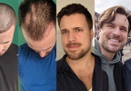 Hair Transplants: The Solution to Quick Cash for Your House