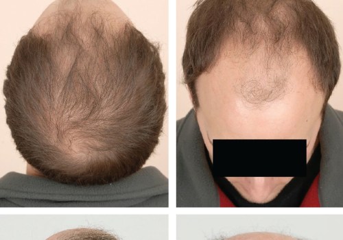 Understanding Hormonal Changes and Male Pattern Baldness