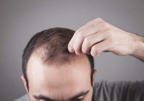 Understanding Thyroid Disorders and Hair Loss