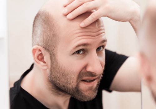 Lifestyle Factors and Male Pattern Baldness: Understanding the Connection