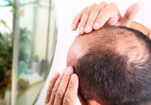 Medical treatments for male pattern baldness: Everything You Need to Know