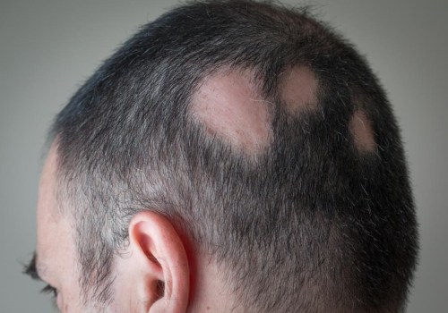 Understanding Alopecia and How to Sell Your House Quickly