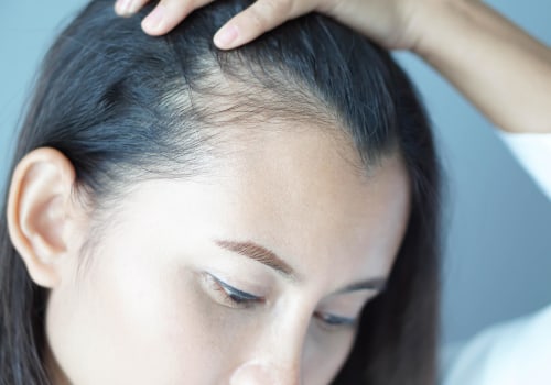 Lifestyle Factors and Female Hair Loss: Understanding the Causes and Risk Factors