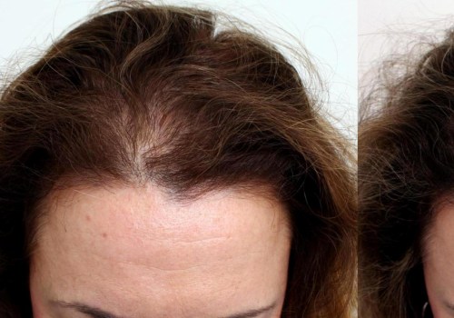 Diagnosing Female Hair Loss: Understanding the Causes and Treatment Options